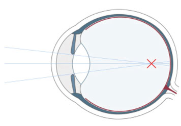 Kurzsichtigkeit verstehen und beheben
